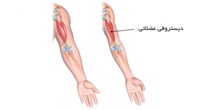 دیستروفی عضلانی چیست؟