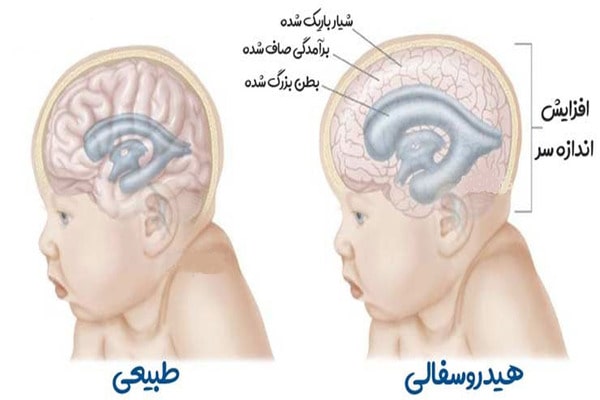 هیدروسفالی در کودکان و بزرگسالان: تفاوت‌ها و راهکارهای درمان