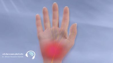 سندرم تونل کارپال(CTS)