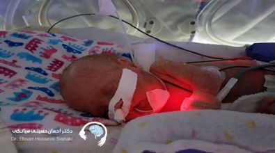 خونریزی مغزی در کودکان نارس